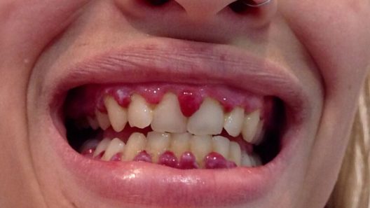 scorbut, carence, vitamine C, résurgence, nutrition, maladie, précarité, prévention, alimentation, santé