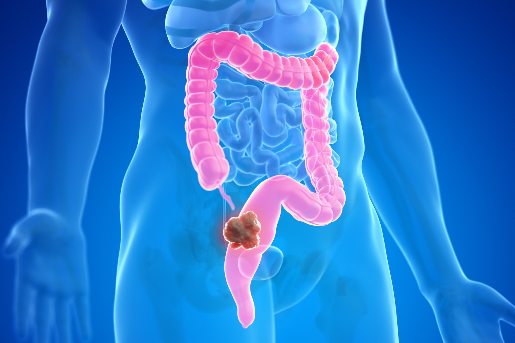 Comprendre le cancer du côlon et les solutions de prise en charge à Bordeaux